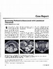 Research paper thumbnail of Sclerosing peritonitis associated with luteinized thecomas