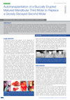 Research paper thumbnail of Autotransplantation of a Buccally Erupted Matured Mandibular Third Molar to Replace a Grossly Decayed Second Molar