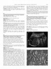 Research paper thumbnail of Rapidly Progressive Synchronous Uterine Papillary Serous Carcinoma (UPSC) in Both Horns of a Uterus Didelphys