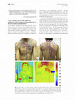 Research paper thumbnail of A case of lung cancer with unilateral anhidrosis and contralateral hyperhidrosis as the first clinical manifestation