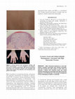 Research paper thumbnail of Extensive Facial and Orbital Infantile Hemangiomas Associated with High Intraocular Pressure