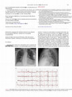 Research paper thumbnail of Perforación subaguda del ventrículo derecho tras implante de marcapasos definitivo: utilidad de la tomografía computarizada