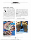 Research paper thumbnail of Picture of the month-quiz case. Fanconi anemia