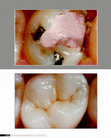 Research paper thumbnail of Coroas Endocrown - uma Opção para Dentes Posteriores Desvitalizados