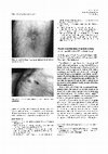 Research paper thumbnail of Placebo-controlled study of psoriasis patients treated topically with a 10% cyclosporine gel