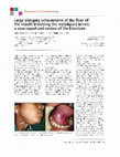 Research paper thumbnail of Large plunging. schwannoma of the Floor of mouth involving the mylohyoid nerve