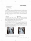 Research paper thumbnail of Enfisema Lobar Congênito