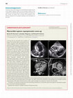 Research paper thumbnail of Myocardial rupture: asymptomatic cover-up