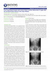 Research paper thumbnail of Cross Fused Renal Ectopia with Uretero-Pelvic Junction Obstruction in Upper Moiety and Renal Pelvis Stones in the Lower Moiety