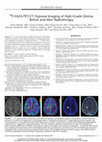 Research paper thumbnail of 18F-FAZA PET/CT Hypoxia Imaging of High-Grade Glioma Before and After Radiotherapy