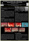 Research paper thumbnail of Treatment of a maxillary labioversed central incisor with root duplication