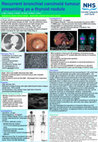 Research paper thumbnail of Recurrent bronchial carcinoid tumour presenting as a thyroid nodule