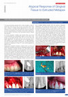 Research paper thumbnail of Atypical Response of Gingival Tissue to Extruded Metapex