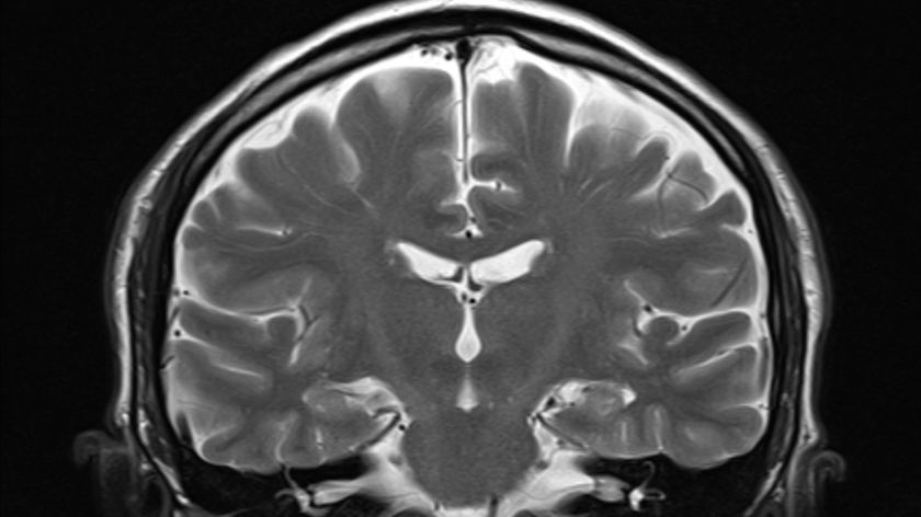 A healthy human brain under an MRI scan. 