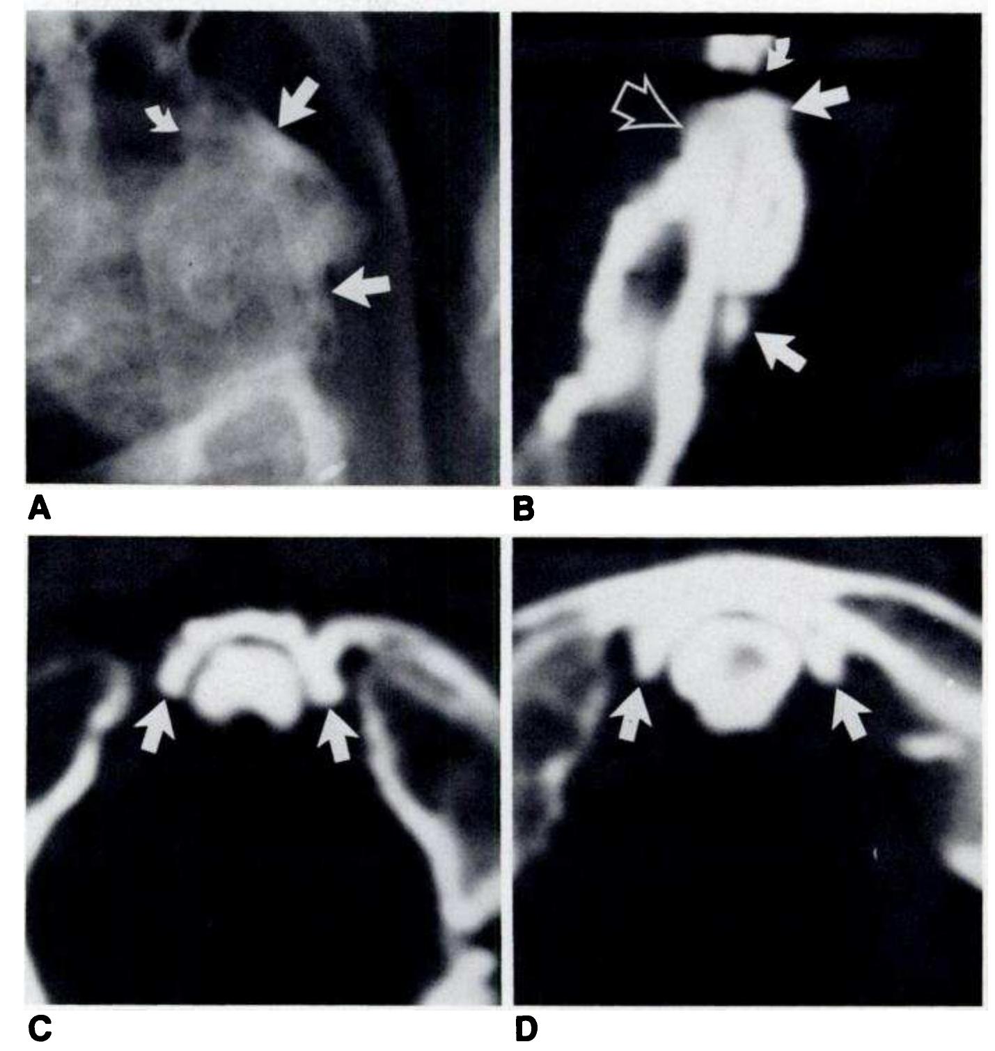 inferior (Figs. 2-4); osteophytes of the median facet of the atlas (Figs. 2-4, 5A and 5C) and odontoid apex (Figs. 2-4); small ossicles within or adjacent to the atlantoodontoid joint (Figs. 3, 5A and 5B); cysts (Figs. 3 and 5B-5D); and calcifi- cation of the transverse ligament (Figs. 5C and 5D).  The most common abnormality was a small bony excres- cence or osteophyte projecting from the odontoid apex, found in 28 (80%) of 35 patients. The next most common findings were similar excrescences from the superior aspect of the anterior arch of the atlas in 24 (69%) and from the median facet of the atlas with the odontoid in 20 (57%). Small ossicles not attached to either bone were found in 12 patients (34%), and cystic radiolucencies within the odontoid process were found in 11 patients (31%). Four patients (11%) had trans- verse ligament calcification; six (17%) had osteophytes from the inferior aspect of the anterior arch of the atlas. Four patients (11%) showed obliteration of the atlantoodontoid joint on at least one axial slice. 