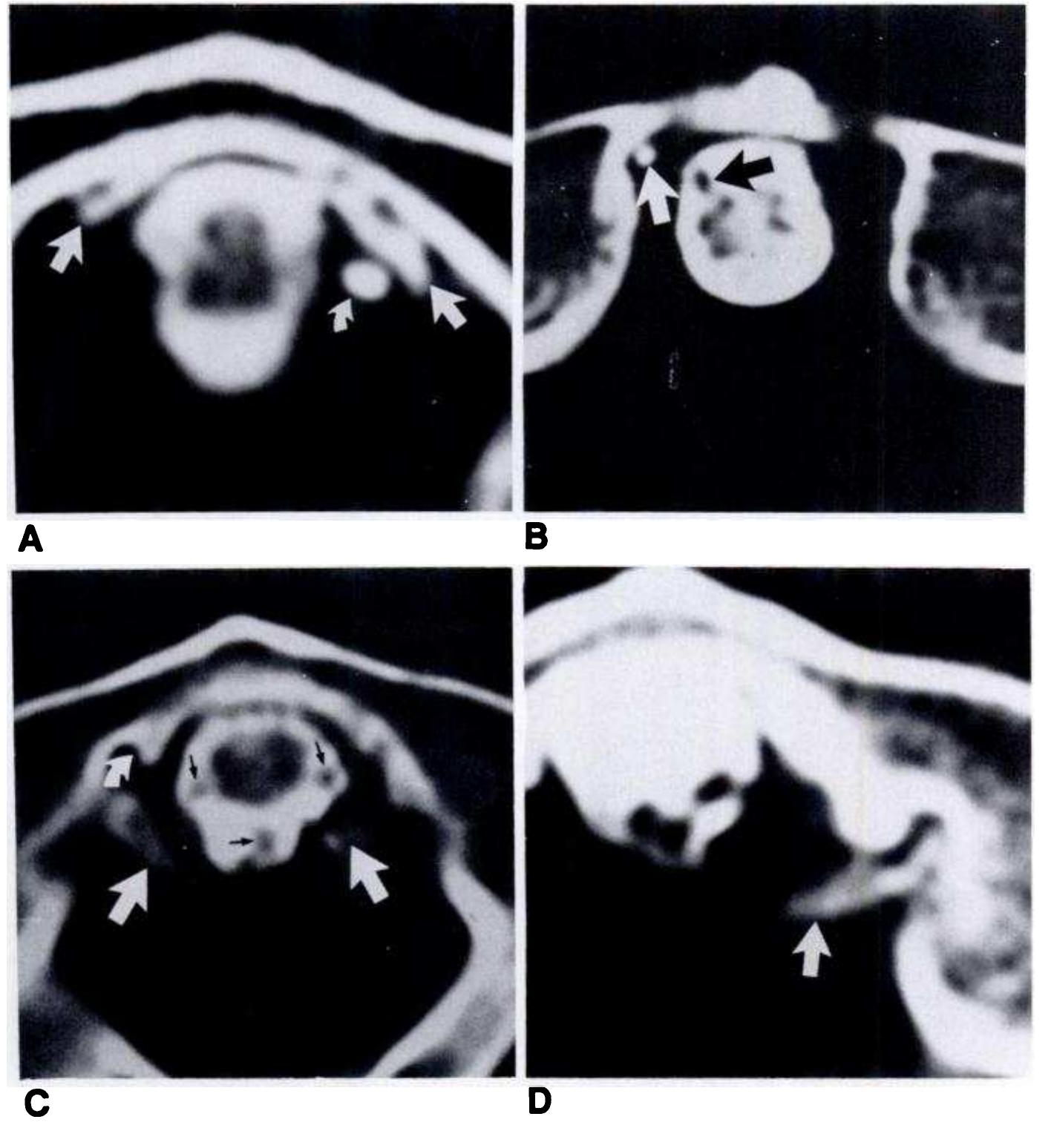 phytes of the anterior arch of the atlas, the odontoid, or the median facet of the atlas in 32% of specimens. The age at death of these specimens is unknown. In a study of 125 cases dating back to 1942, Von Torklus and Gehle [3] found that osteoarthritis of the atlantoodontoid joint was in 36% of patients 41-50 years old and in 88% of patients over 60. Harata et al. [2] noted changes from atlantoodontoid joint osteoarthritis on radiographs in 88% of a selected group of 31 patients with atlantoaxial lateral facet arthrosis. Their histologic examination of a cadaver specimen showed carti- lage thinning, fibrillation, and ossification. 