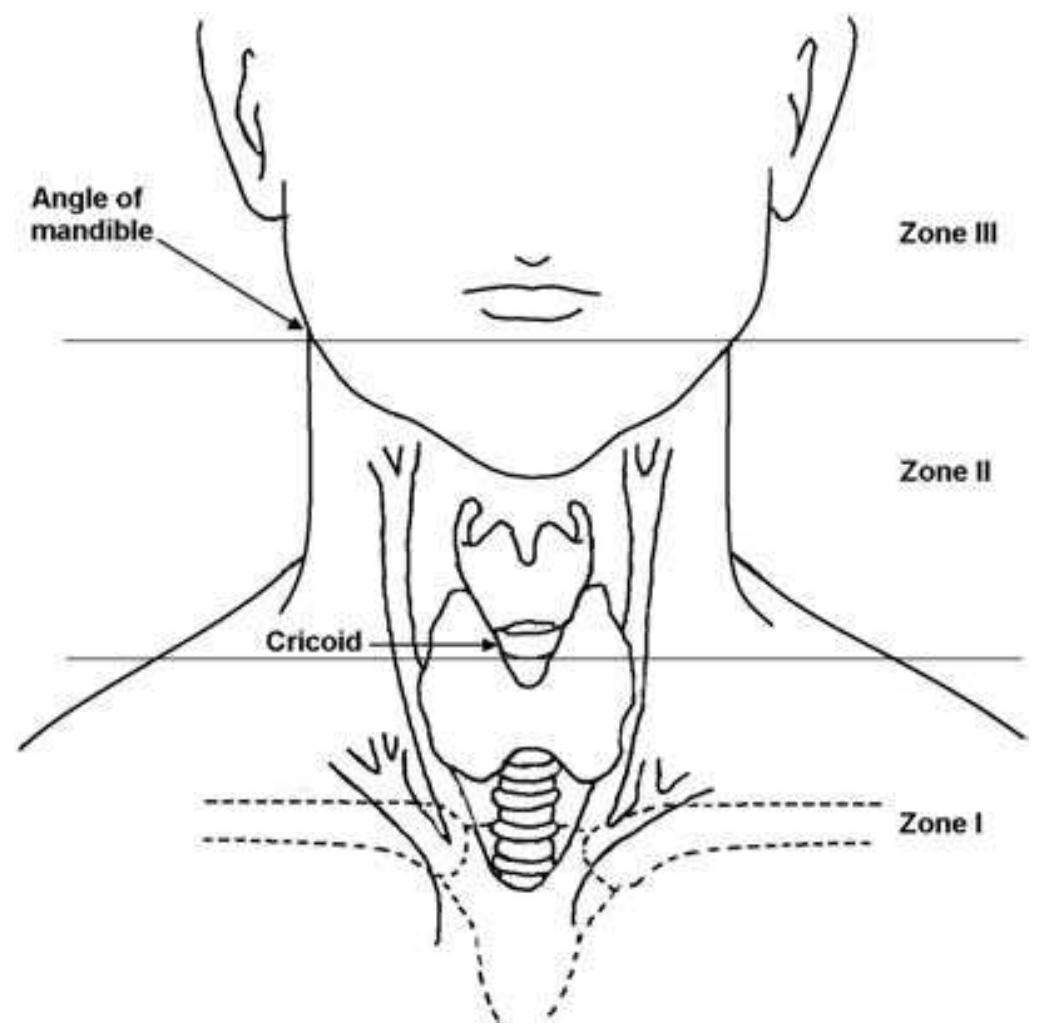 Ficure 23-2. Zones of the neck for penetrating injury. (From Maxwell, RA. Pene- trating Neck Injury. In: Peitzman AB, Rhodes M, Schwab CW, Yealy DM, Fabian TC, eds. The Trauma Manual. Philadelphia: Lippincott Williams & Wilkins; 2002:192, with permission) (See also Figure 11-3.)  Finally, these invasive diagnostic procedures carry a small but real ‘ate of complications and take considerable time.”’ In the evaluation of ess-invasive diagnostic techniques, Montalvo found cervical color duplex sonography to be an accurate alternative to angiography in stable patients vith Zone II or Zone III injuries who were not actively bleeding.” Accu- ‘ate cervical duplex ultrasound is often not readily available, is operator Jependent, and requires specialist expertise in interpretation. In addition, his technology is limited by patient habitus, does not image skull-base njuries, and does not impact the need for evaluation of the aerodigestive ract. These issues have led a number of surgeons to question whether rigid ilgorithmic protocols for invasive evaluation of victims of gunshot wounds 