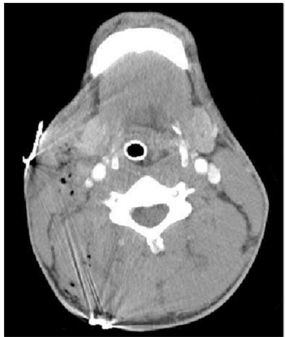 Ficure 23-3. Computed tomography after gunshot wound to the neck with clear demonstration of trajectory. Injury to the patient’s carotid artery, oropharynx, and tracheobronchial tree are excluded. (See also Figure 11-5.)  wound bubbling, airway compromise) after gunshot wound to the neck are candidates for trajectory determination and injury identification by con- trast-enhanced CT (Figure 23-3). Injuries to the trachea, oropharynx, cer- vical esophagus, and important vascular structures can be readily identified. Using helical CT as a triage tool, trauma surgeons can choose to pursue operative intervention as necessary or obtain further individual diagnostic studies where appropriate, including interventional angiography for defin- itive endovascular repair in selected cases.'° If helical CT is not available, or if the findings on CT scan are inconclusive or do not match clinical find- ings, traditional methods of evaluating penetrating neck trauma with diag- nostic angiography, endoscopy, esophagography, or operative exploration should be pursued. 