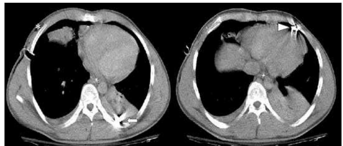 Ficure 23-5. Chest CT of patient in Figure 23-4. Asterisk demonstrates one entrance wound. Anterior and posterior foreign bodies are seen (arrow). The medi- astinal structures are clearly at risk for injury and further studies are needed. 