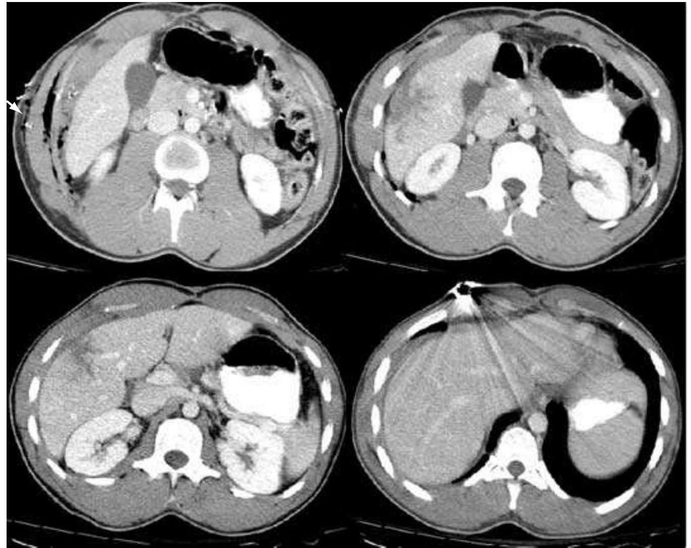 Ficure 23-8. Computed tomography of patient sustaining gunshot the right upper quadrant/flank demonstrating isolated hepatic injury. Arrow marks entrance wound and foreign body (bullet) is seen in the last image of the sequence. This patient was successfully managed nonoperatively.  Demetriades and colleagues,” in 1999, published a series of 52 patients with gunshot wounds to the liver as diagnosed by CT scan. Of these patients, 16 remained hemodynamically stable, had no other indication for laparotomy, and were successfully managed nonoperatively. Although a 