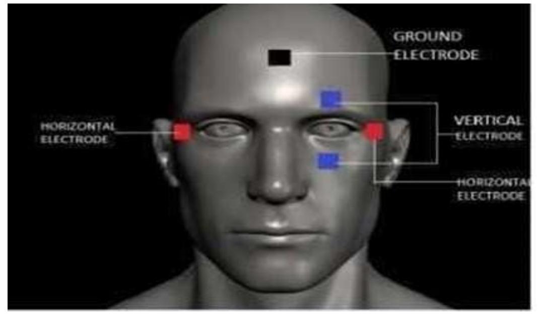 Horizontal and vertical electrodes are placed across the eyes in horizontal and vertical position respectively in order to get left- right and up-down positions of eye ball as per Fig. 1. Ground electrode is placed on forehead and is connected to the DC ground of the electronics circuit. Signals from the electrodes are amplified and processed using instrumentation amplifier. Output of the instrumentation amplifier is given to 10 bit ADC of Microcontroller refer Table 1 for signal level. Initially operator has to look in forward direction to get reference signal value because reference signal may vary from operator to operator. For the operator to move in a required direction, he/she directs his/her eye in that direction and the acquired signal is compared with the reference signal registered in microcontroller at initialization of program. Decision is taken on the basis of profile of the signal and control signals are given to motors of the wheelchair to move in the desired direction. To stop the motors, operator has to look in upward direction and to start the motors, he/she has to look in downward direction  Fig. 1. Placement of electrodes 