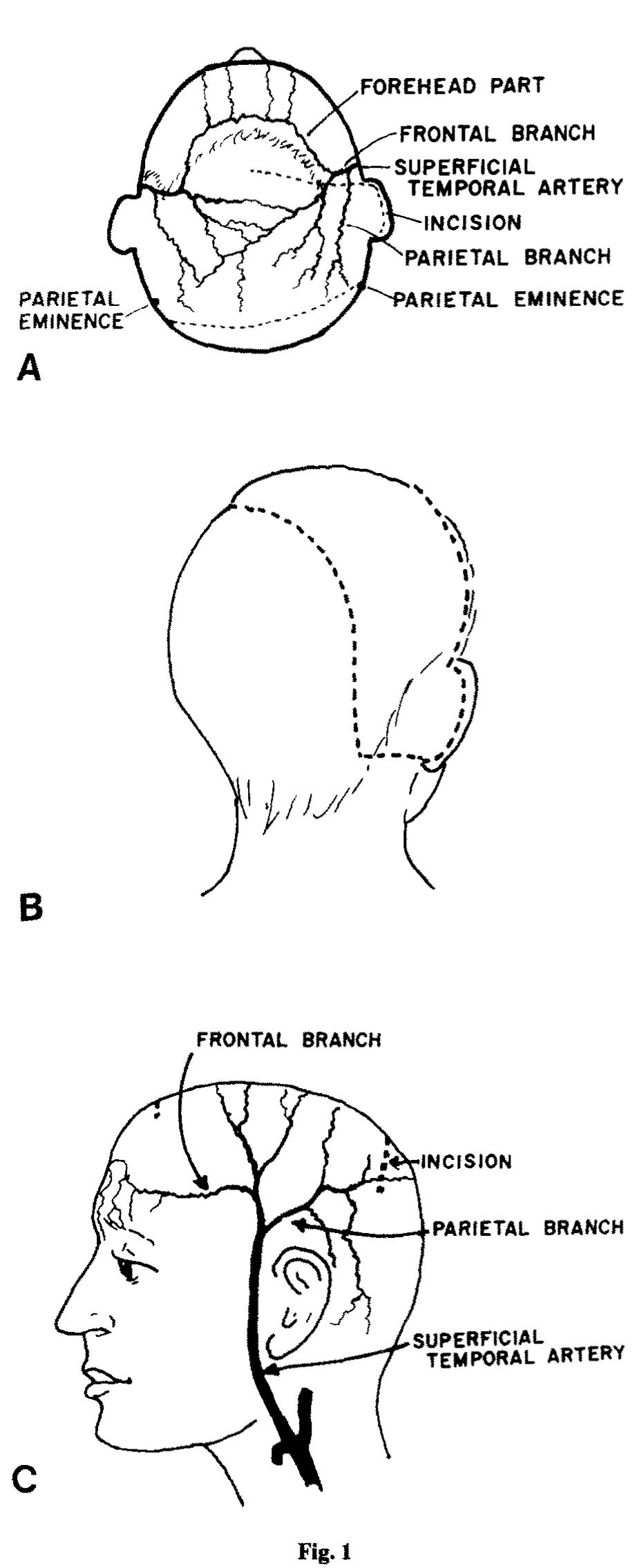 Figure 1—{A) The relation of the flap incision to the vascular network. The forehead branch (ipsilateral) escapes the incision and anastomosis with the contralateral forehead branch and both the supraorbital and trochlear branches bilaterally. (B) The  delineation of the flap on the ipsilateral side. (C) The vascular pattern on the contralateral side (base). 