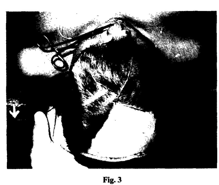 Figure 3—Perfusion studies in the cadaver showing communi- cation between the two frontal branches, dye injected at one end and coming out at the other end (arrowed). 