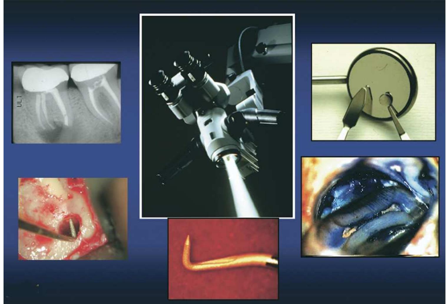 Figure 1. Pictoral representation of endodontic microsurgery. From top center clockwise: micromirrors, isthmus, ultrasonic KiS tip, KiS tip positioned for root-end preparation, radiograph of resected apex, and MTA root-end filled apices. 