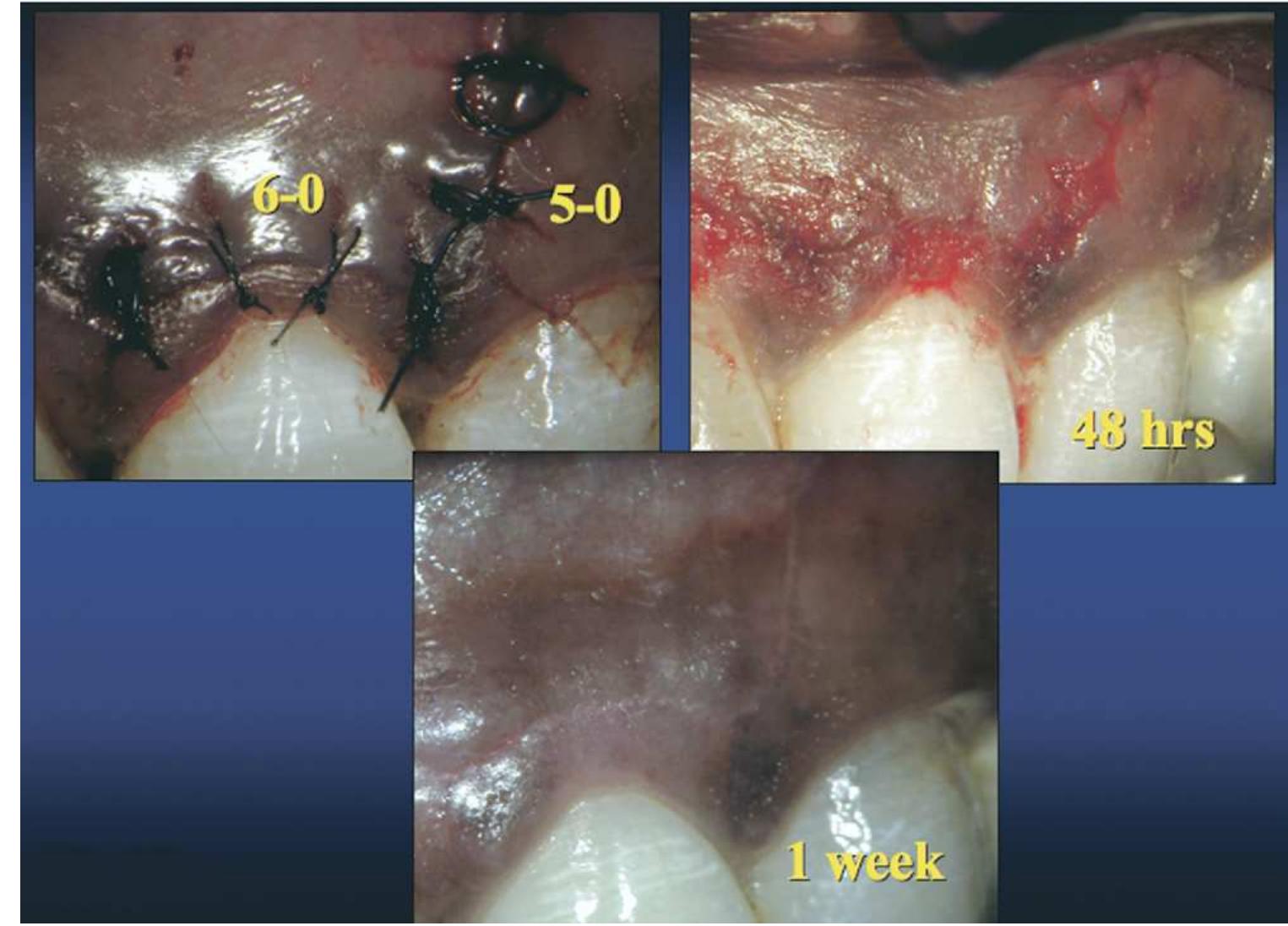 Figure 7. Micro-suturing with 5 X 0 and 6 X 0 monofilament sutures (top left); suture removal after 48 h (top right) and tissue healing 1 wk postoperatively. 