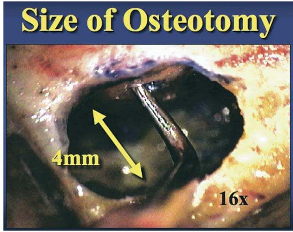 Figure 9. The ideal osteotomy measures ca. 4 mm in diameter allowing a 3 mm ultrasonic tip to move freely within the bone crypt. This by the microsurgical osteotomy is compared with a much larger traditional size osteotomy. (Re- printed with permission from Color Atlas of Microsurgery in Endodontics, by S. Kim with G. Pecora and R. Rubinstein. W.B. Saunders Co., A Harcourt Health Sciences Company, 2001.) 