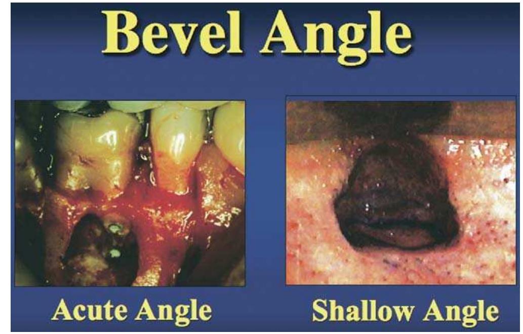 Figure 10. A comparison of a large osteotomy and acute bevel angle made by the traditional bur method (left) with a smaller osteotomy without bevel angle, made by the microsurgical method (right). The image at right is 10 larger than the left image. 