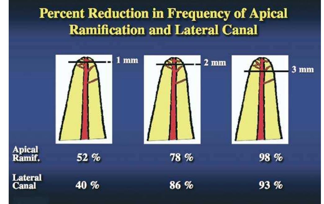 Figure 11. Frequency of apical ramifications and lateral canals. A 3-mm apical resection was needed to eliminate the majority of apical ramifications and lateral canals. (Reprinted with permission from Color Atlas of Microsurgery in Endodontics, by S. Kim with G. Pecora and R. Rubinstein. W.B. Saunders Co., A Harcourt Health Sciences Company, 2001.) 