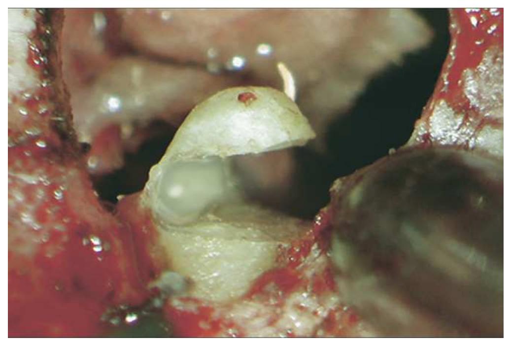 Figure 12. A digital image of a 3 mm apical resection on a maxillary premolar. (Photo by Dr. F. Maggiore, Germany.) 