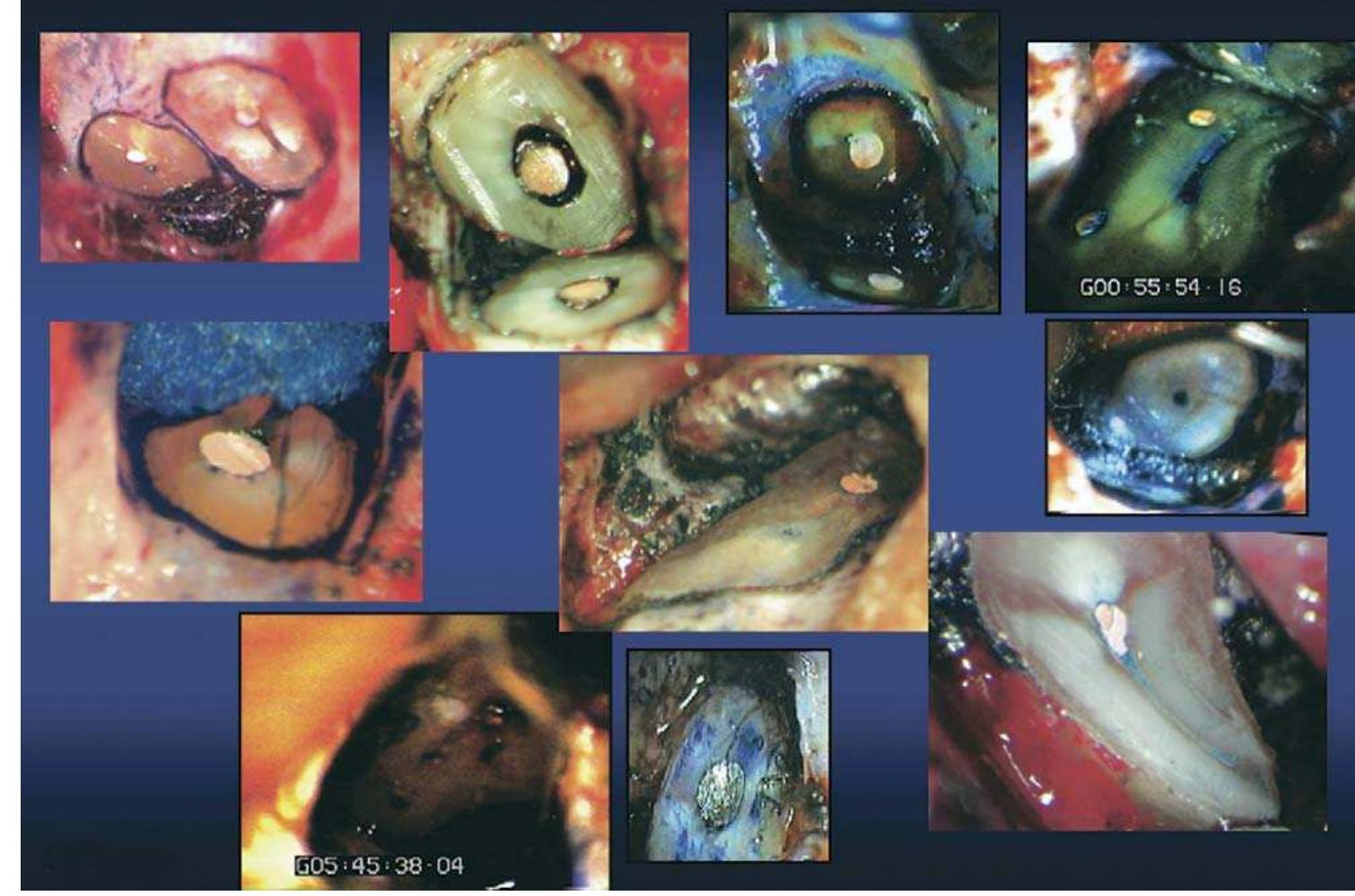 Figure 13. Inspection of this resected root surfaces shows several types of apical configurations, isthmi and anatomies. 