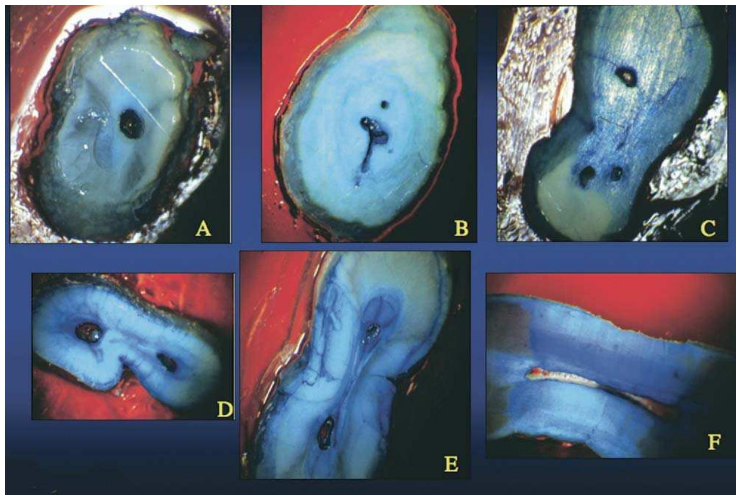 Figure 15. Inspection of resected root surfaces of extracted teeth reveals many different types and shapes of isthmi. (A) Shows an infrequently seen round apex. (B) Shows a modified type 1. (C) has several apices with a type | isthmus. (D) Is a type IL isthmus, (£) is a type IV, and (F) a type V. The classification is based on Hsu and Kim (55). The majority of molar isthmi are types IV and V. 