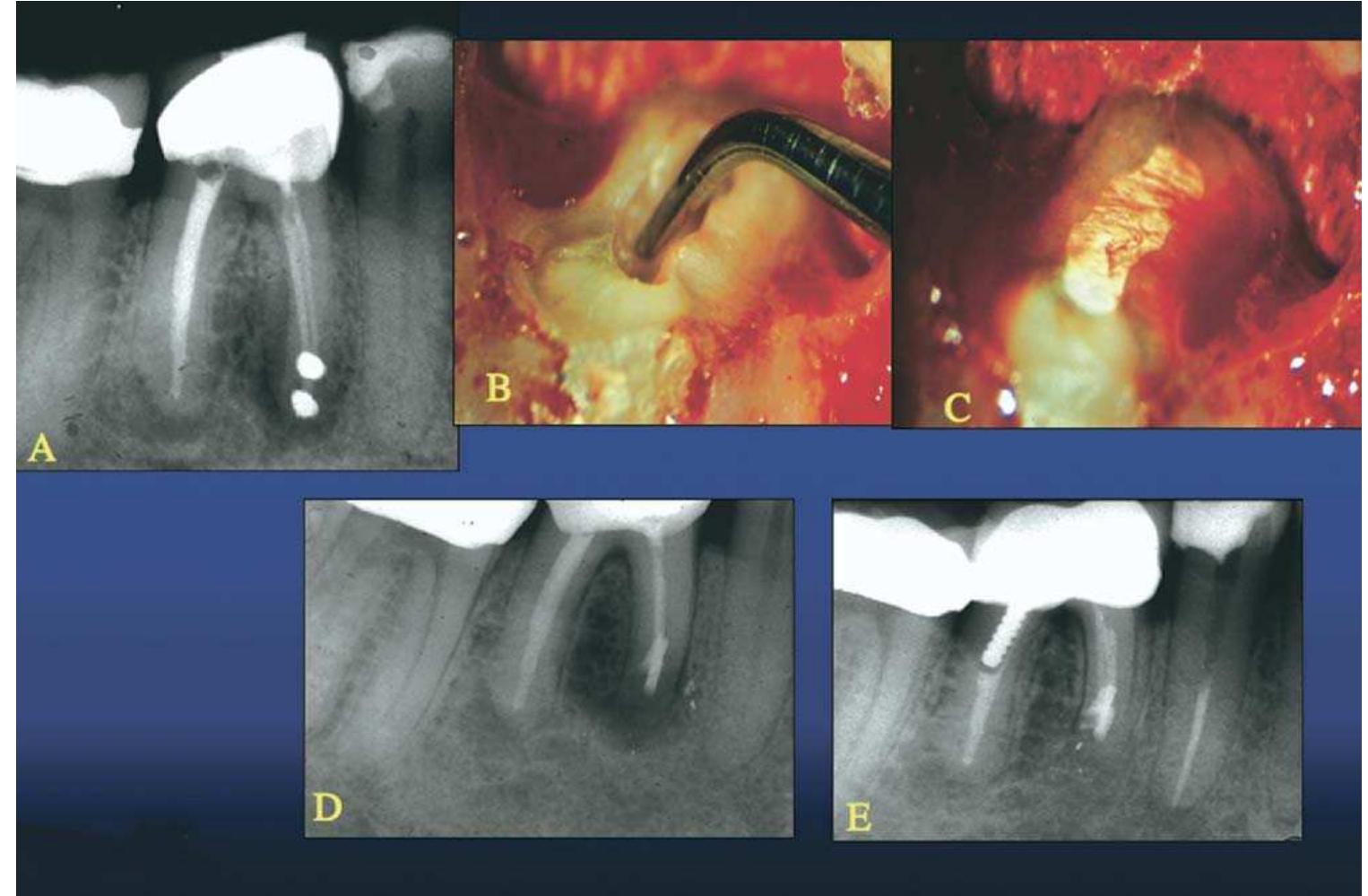 Figure 17. Failed traditional surgical case (A). High magnification of root-end preparation with an isthmus (B). Obturation of root-end in C with SuperEBA shown at 16X magnification. Note elongated root-end filling covering two apices and connecting the isthmus (C). Radiograph immediately after surgery (D) and 1 yr postsurgery (Z), showing complete healing. (Reprinted with permission from Color Atlas of Microsurgery in Endodontics, by S. Kim with G. Pecora and R. Rubinstein.  W.B. Saunders Co., A Harcourt Health Sciences Company, 2001.) 