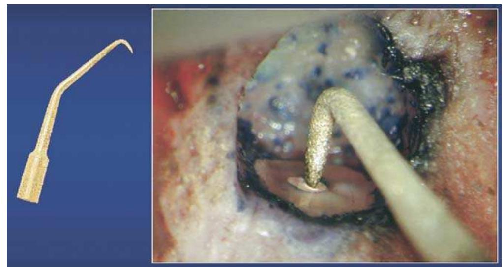 Figure 19. Microsurgical root-end preparation of a maxillary canine with a KiS #1 ultrasonic diamond coated tip (16x). 