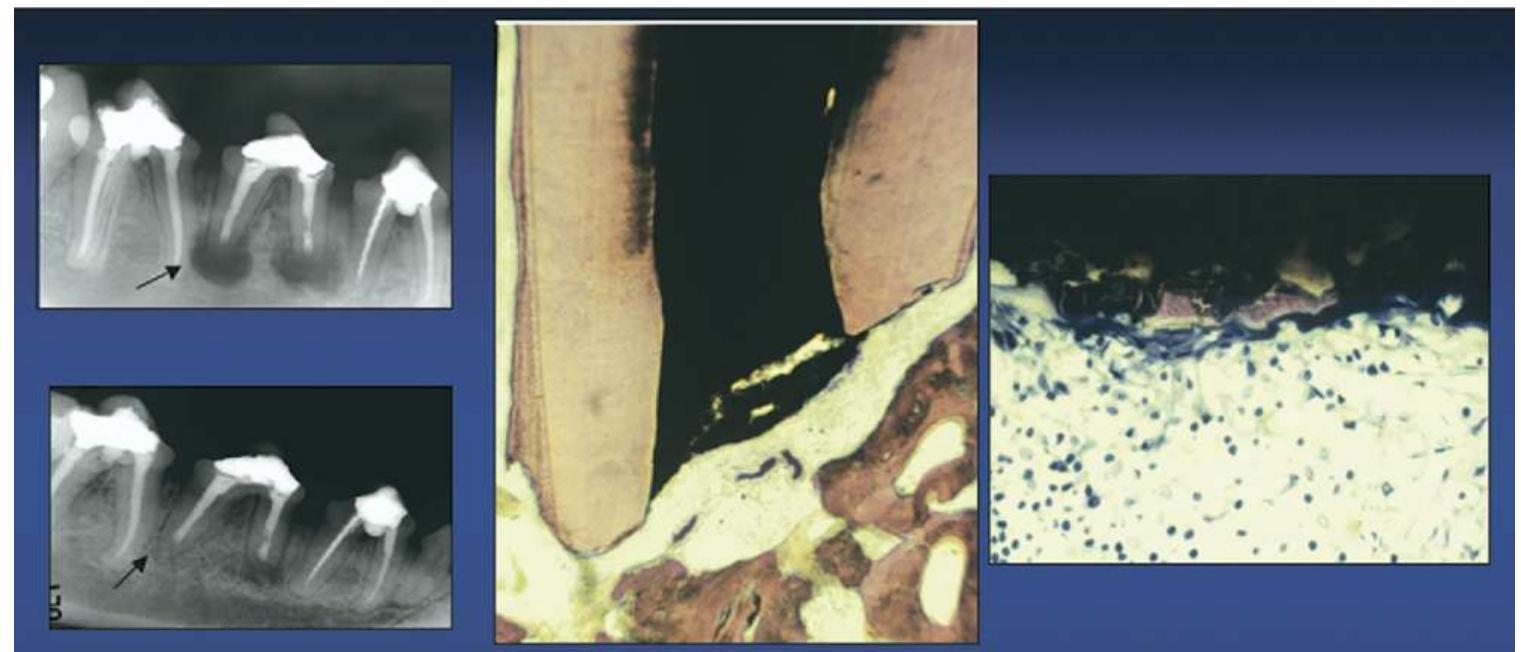 Figure 21. MTA root-end filled apex (mesial root) of a dog tooth showed complete healing at 5 months postoperative (left X-rays). The histological pictures show new bone formation at the surgical site (center) and the absence of inflammatory cells (right) , suggesting a complete resolution of the pathology. The distal apex, showing incomplete healing, is filled with SuperEBA (left X-rays). 