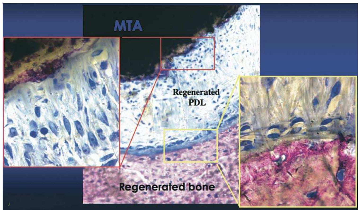 Figure 22. Histological sections of dog teeth root-end filled with MTA show remarkable bone regeneration (yellow frame). At large magnification (right) numerou: PDL-like projections are seen from the bone toward the MTA filling. From the MTA side, numerous PDL-like projections with fibroblasts forming a columnar patterr are seen (left). The regenerated PDL has the same width of ca 0.38 mm, as a normal PDL.  Although additional studies are needed to test wMTA, the pub- lished findings so far indicate that WMTA is comparable to gMTA.  The sealing ability was compared using the bacterial leakage test on perforation repair sites. Ferris et al. (101) tested the ability of both types of MTA to seal off the perforation site and showed that there was no significant difference between the two materials. Also a bacterial leak- 