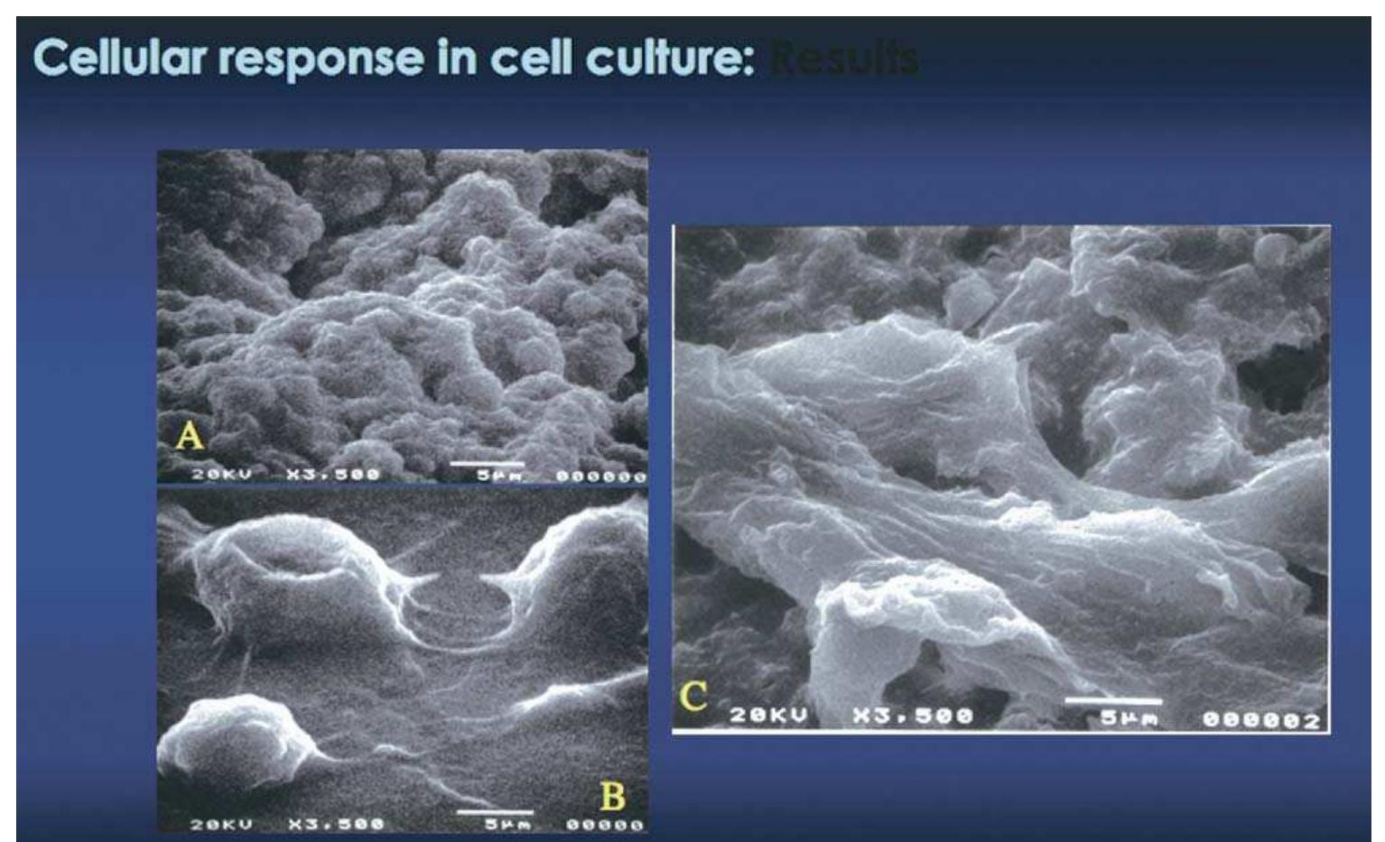 Figure 24. Scanning electron microscope images of gray MTA (4), MDPC23 mouse odontoblast cells (B), and cells grown on MTA (C). MDPC23 cells without MTA appear normal, of a round shape and attached to the plate surface (B). MDPC23 cells grown on gray MTA have a flat appearance, showing robust growth, suggesting that MTA may stimulate cell growth. Electron dispersion analysis was used to differentiate cells from MTA by comparing the Ca”* content.  than it appears on the radiograph (108). A thorough knowledge of the anatomy of the region, as well as taking angled radiographs are essen- tial. It is also essential that the vertical releasing incision is long enough to expose the mental foramen after a careful dissection. Once the fora- men is identified, a retractor is placed to protect the foramen and under the microscope, a horizontal groove is cut just above the foramen (Fig. 8). Although injuring the nerve is extremely rare, transient parasthesia may occur even if the surgical site is far from the nerve. Inflammatory swelling of the manipulated tissues may cause impingement on the mandibular nerve, resulting in transient ipsilateral paresthesia. Normal sensation generally returns within few weeks. Thus, performing surgery on mandibular posterior teeth should not be of great concern, provided that proper preparations are made. At our institution, there has been no case of permanent parasthesia in more than 450 mandibular molar cases since 1992, when microsurgery was first taught and performed by endodontic graduate students.  Generally, the mental foramen is located below and between the apices of the second premolar and the mesiobuccal root of the first molar. More precisely, its most common location is inferior to the crown of the second premolar (62.7%) (107), and it is always larger 