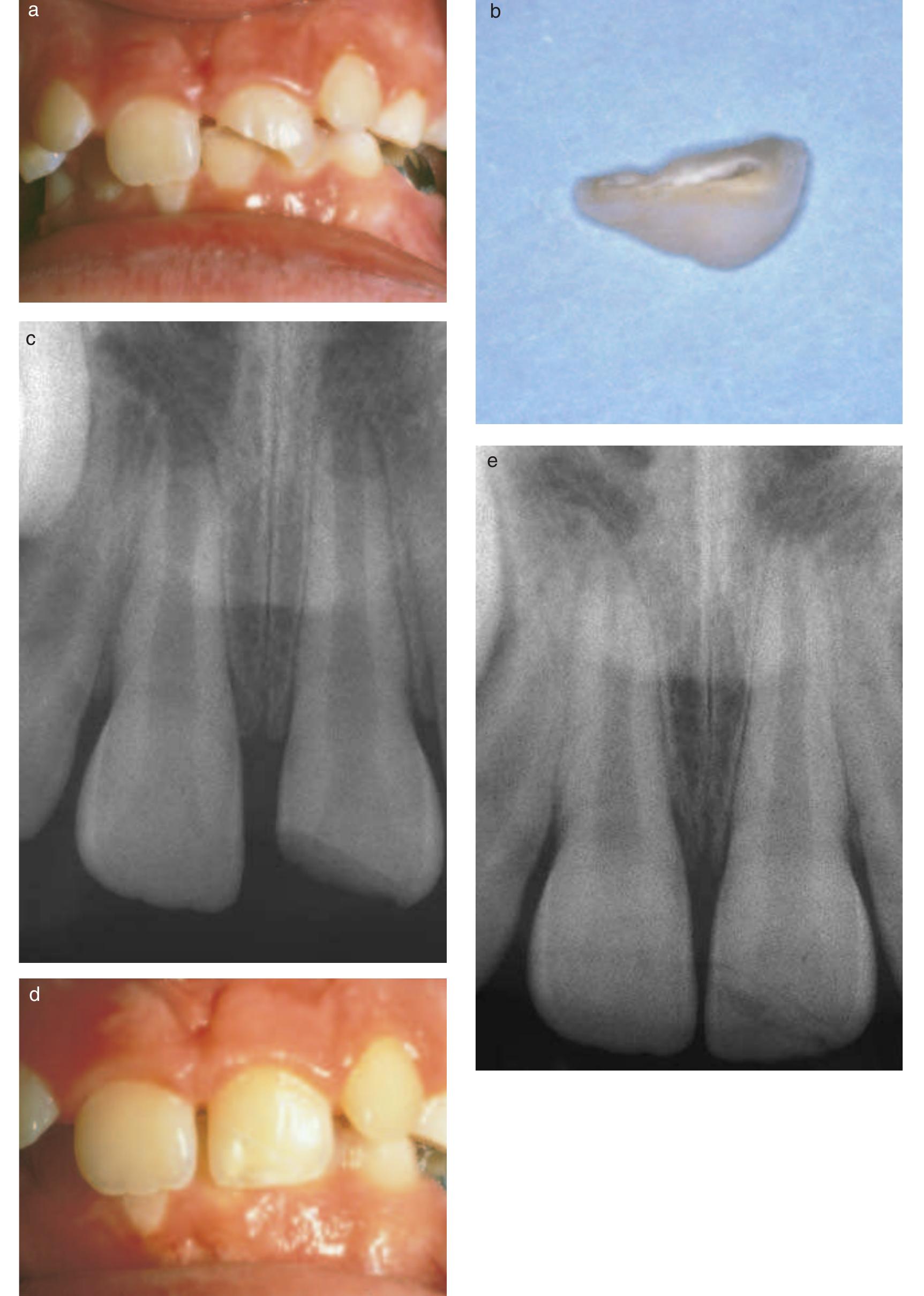 Fig. 11. Bonding fractured crown. (a) Photo showing maxillary left central incisor of an 8-year-old boy who fractured the tooth in an accident. (b) His mother saved the broken fragment allowing it to be rebonded. (c) Radiograph shows development stage of the tooth; protecting the pulp by bonding the crown fragment is desirable. (d) Photo shows result of bonding. The fracture line can be additionally covered with composite resin. (e) Radiograph 8 months later shows continued root development with apical closure, indicating normal pulpal function. (Courtesy of Dr Todd Milledge, pediatric dentistry, Loma Linda University, Loma Linda, CA, USA.) 