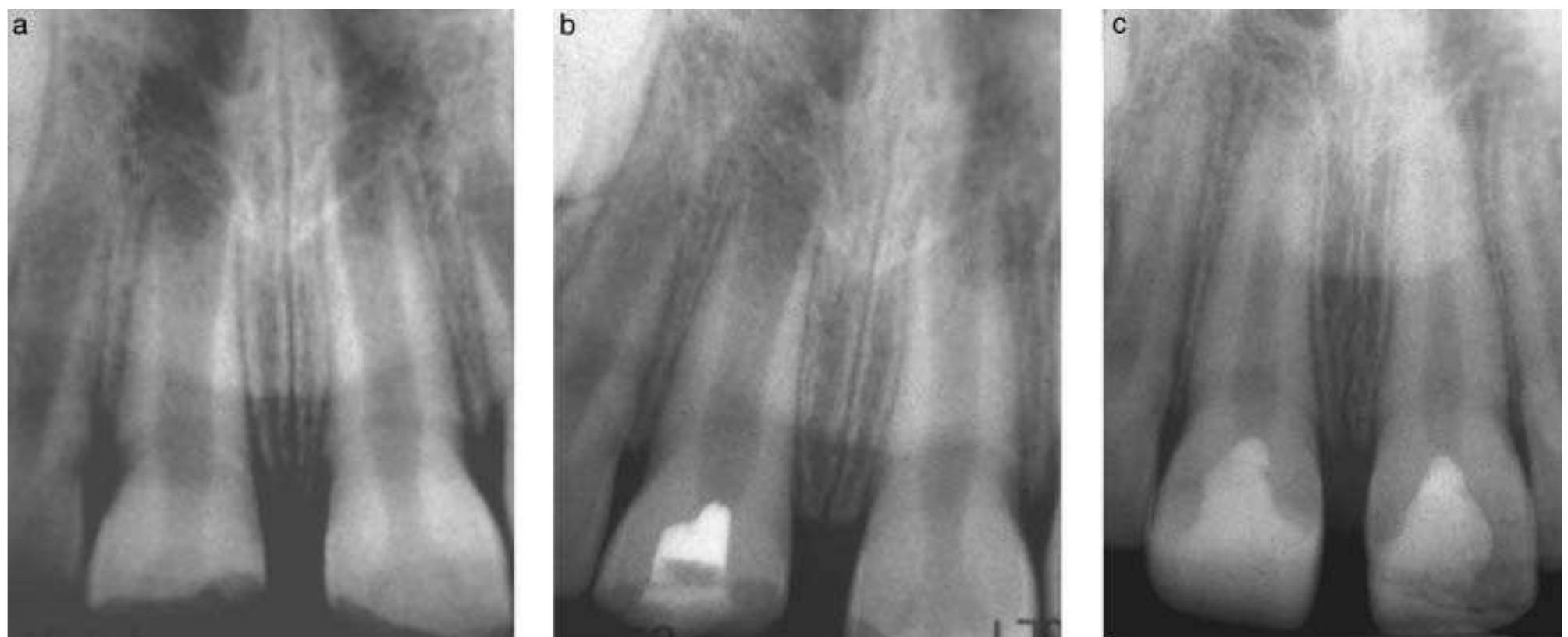 Fig. 12. The use of mineral trioxide aggregate (MTA) for vital pulp therapy. (a) Two fractured central incisors in an 8- year-old boy who suffered a traumatic accident. The pulps in both teeth were exposed. (b) Radiograph shows initial treatment with MTA in the right incisor; the same procedure was performed on the left incisor. (c) Radiograph of the two incisors 3 years post-treatment. Note the continued root development indicating normal pulpal function in both teeth. 