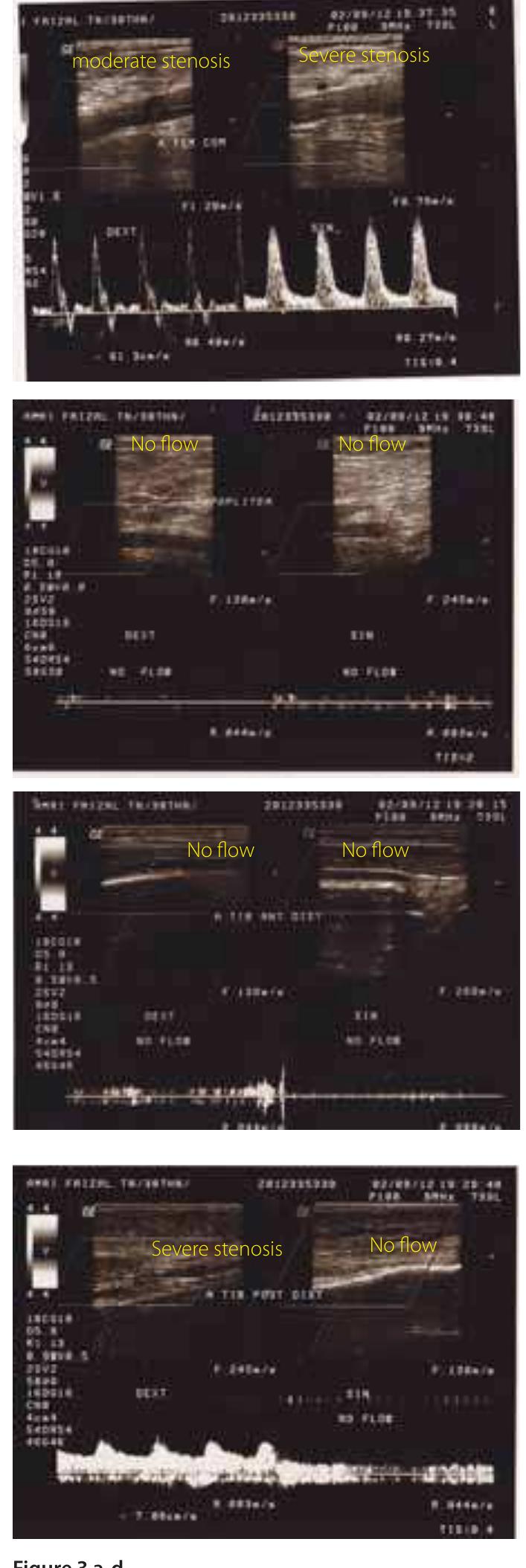 4. Left iliaca artery, communis femoralis artery, poplitea artery, posterior-anterior tibialis artery occlusion. 