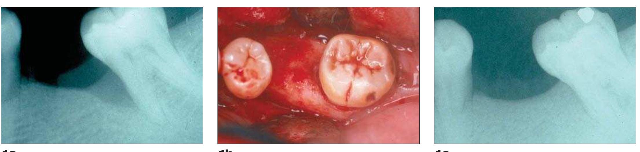 Figure 1. Radiographs of a guided tissue regeneration case utilizing a nonresorbable ePTFE membrane. The mesially inclined molar is associated with a three-walled intraosseous defect (Figures la-b). The defect was filled with demineralized and mineralized freeze-dried bone allografts, and ePTFE was used. Membrane was exposed after eight weeks and removed two weeks later. Radiographic “fill” was halfway after six months and maximum fill was present after  12 months (Figure 1c) with minimal probing depth. 