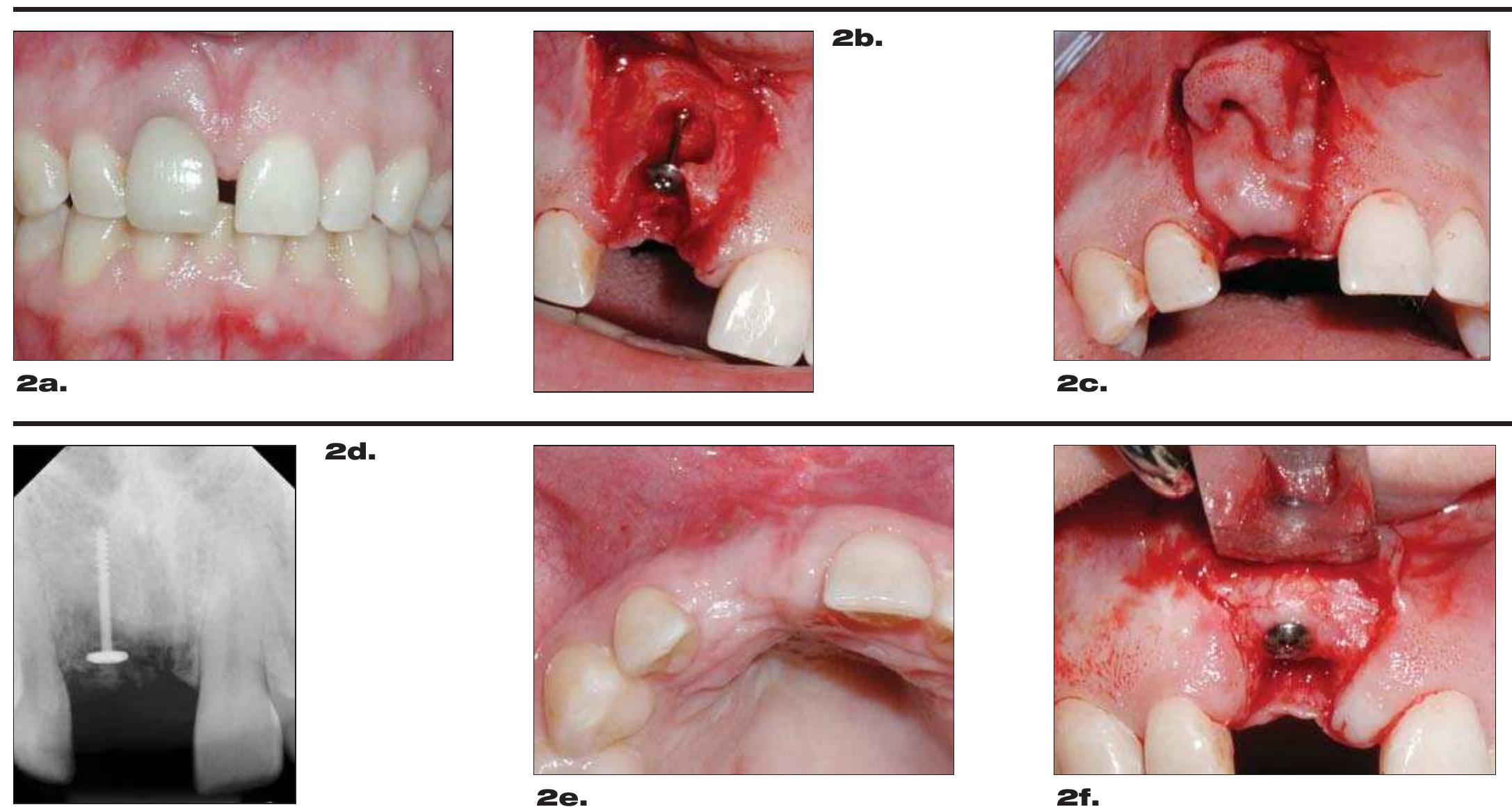 Figure 2. Tooth No. 8 has 8 mm pocket depth on the labial with a probable root fracture (a). Following extraction, extensive loss of the buccal plate is present. A 10 mm bone screw was placed (b). The defect was filled with human bone allograft and covered with a resorbable membrane (c). Without the mechanical barrier effect of the guided bone regeneration membrane and the supporting tenting screw, replacement would not be possible. After four months, radiograph is suggestive of bone fill (d), and the horizontal (e) and vertical (f) deficiencies were corrected adequately for the placement of a dental implant (f). 