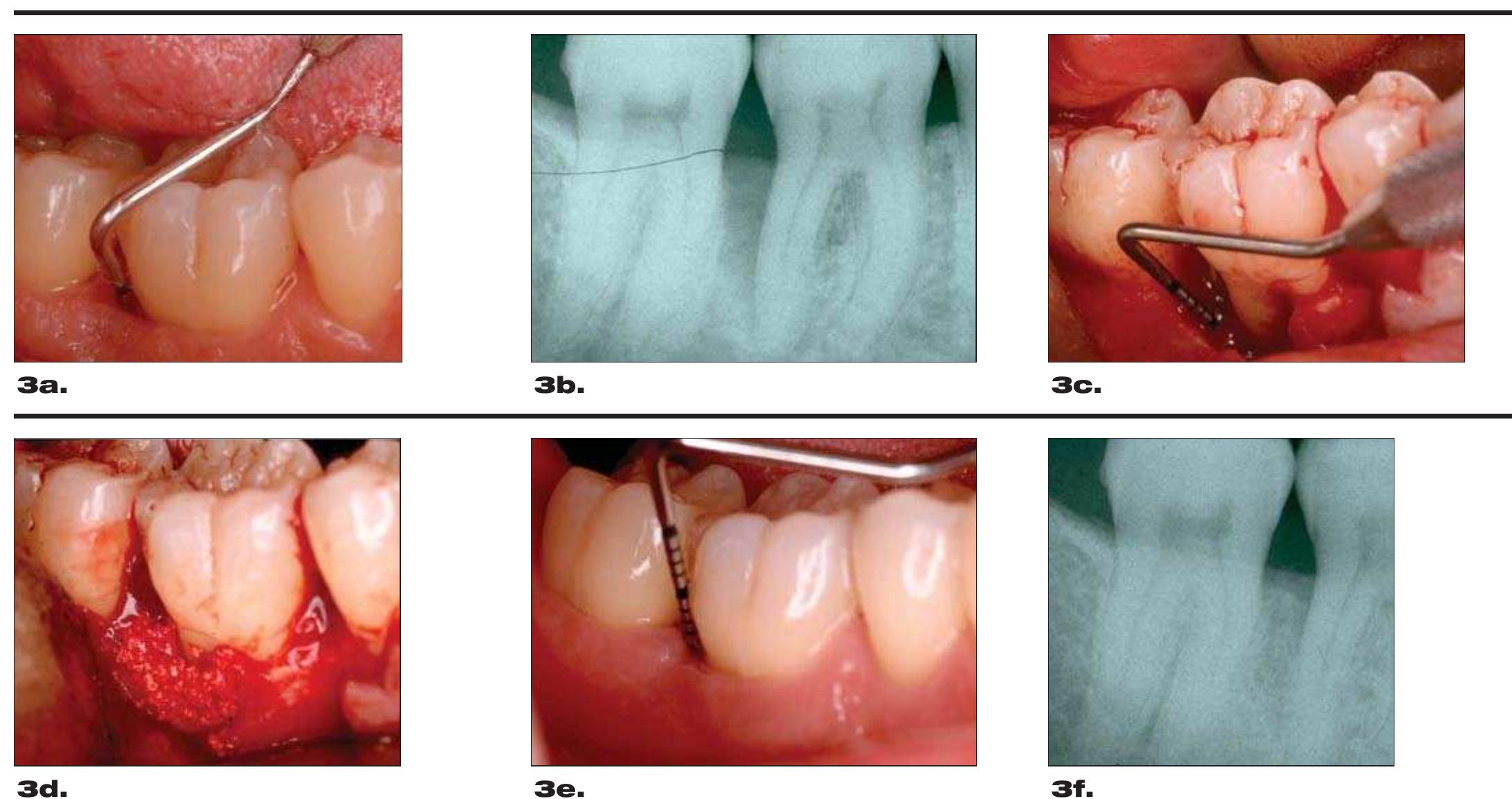 Figure 3. A 13 mm pocket depth was present on No. 30D (a) with radiographic bone loss to the apical quarter of the tooth (b). After flap curettage, the osseous defect was determined to be a 10 mm three-walled osseous defect (c). A soon-to-be commercially available rhPDGF-TCP mixture was used to fill the osseous defect (d). After six months, the pocket depth was 4 mm (e) and evidence of radiographic fill was present (f). 