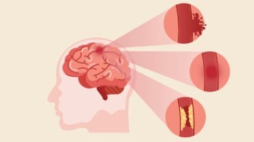 symptoms of stroke