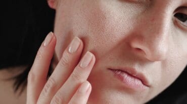 open pores se chutkara paen