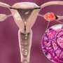ovarian cancer ke lakshan silent ho sakte hain.