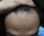 M字戦線異状あり〜SBC自毛植毛ブログ〜
